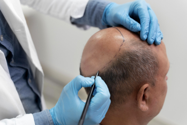 tepe-bolgesi-sac-ekimi